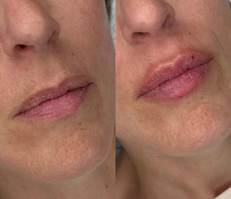 Antes y después labios finos tratados con hialurónico