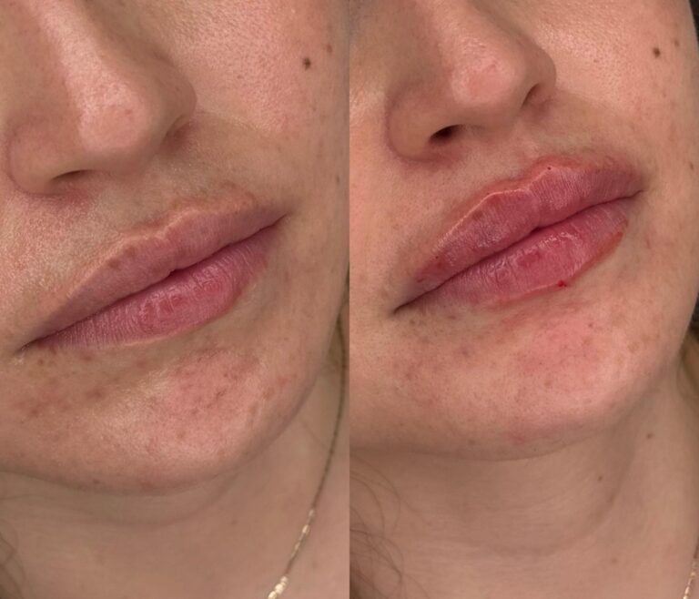 Aumento de labios sutil - paciente clínica Madrid
