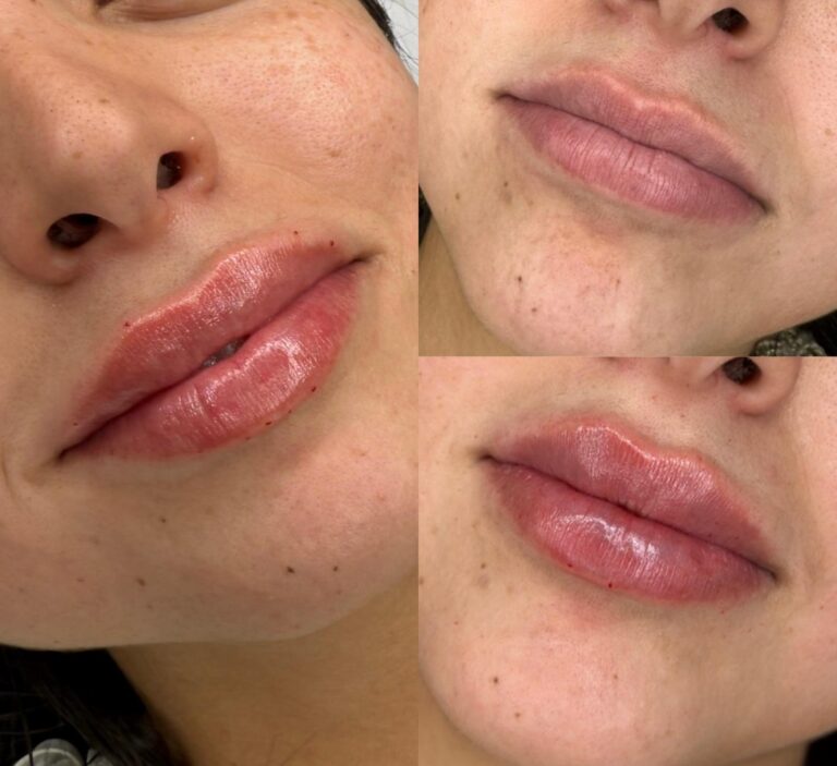 Labios perfilados y naturales - clínica Madrid