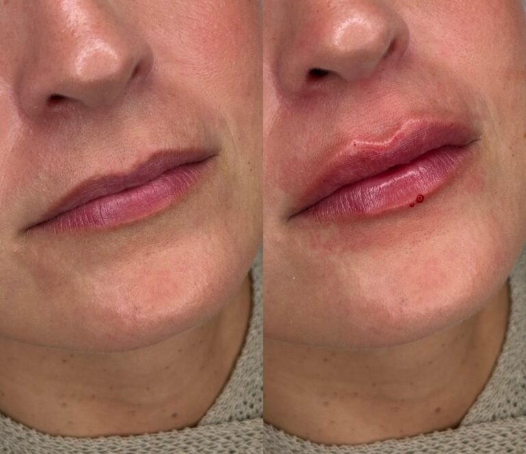 Perfilado de labios natural Madrid - caso real
