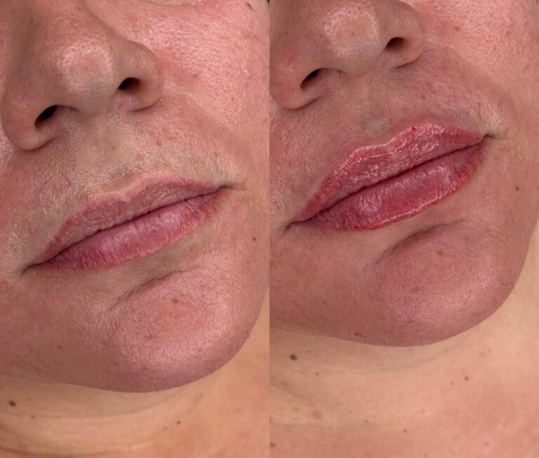 Relleno de labios Dra. Sandra Hermida - antes y después