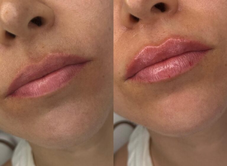 Relleno de labios con ácido hialurónico Madrid
