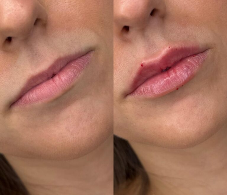 Resultado aumento de labios sin sobrecorrección