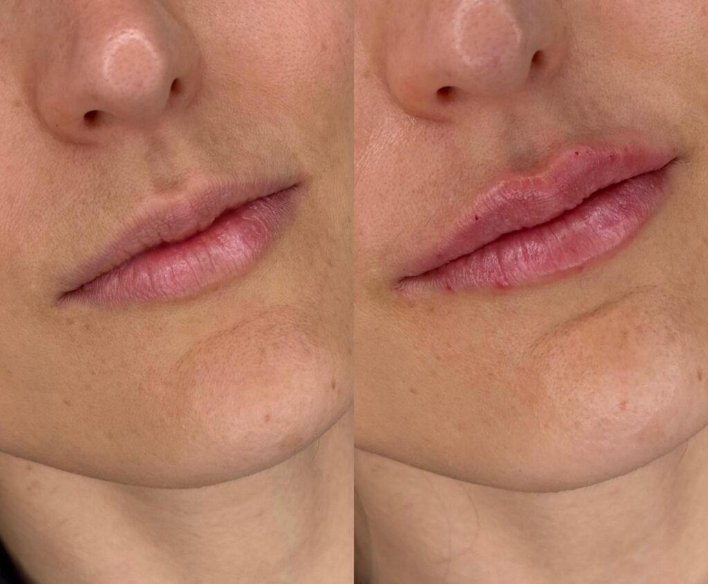 aumento de labios con acido hialuronico