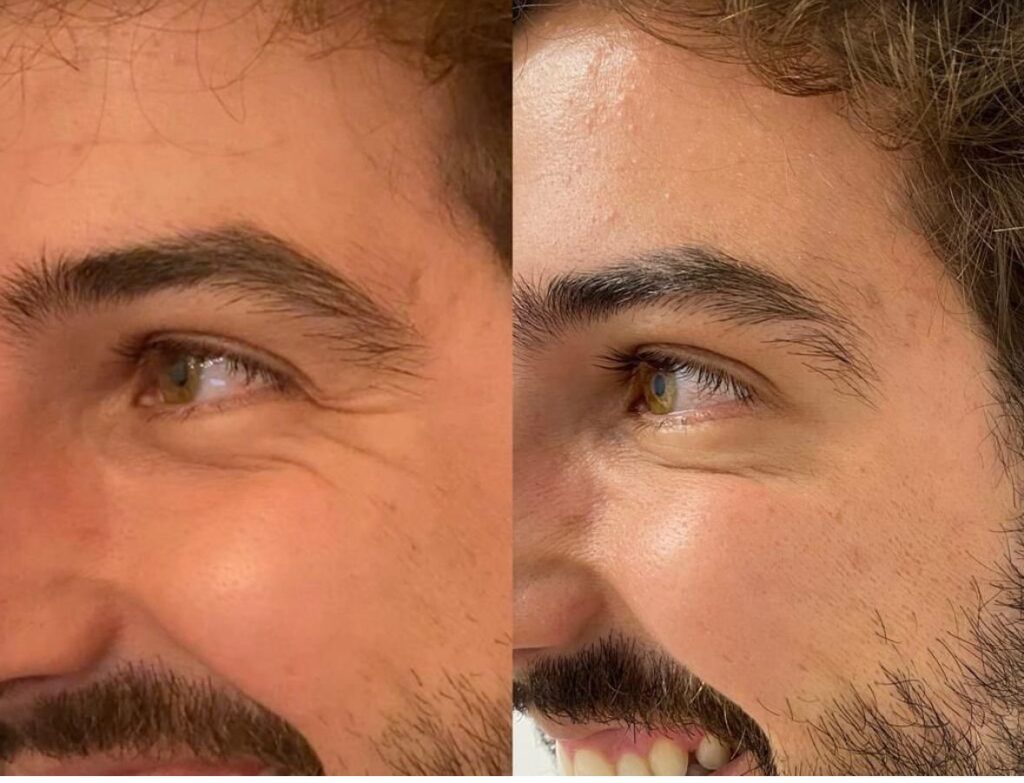 tratamiento antiarrugas hombre