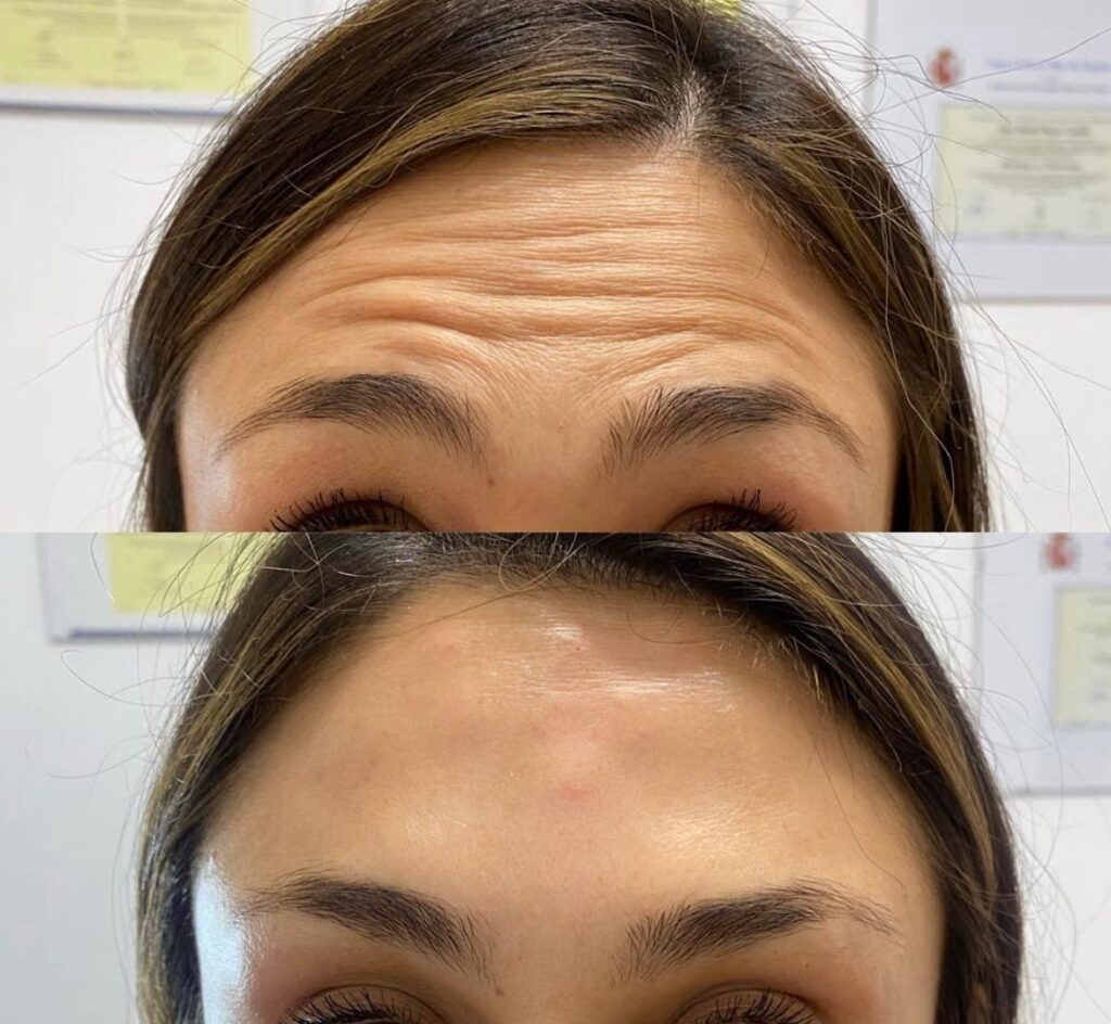 tratamiento antiarrugas mujer