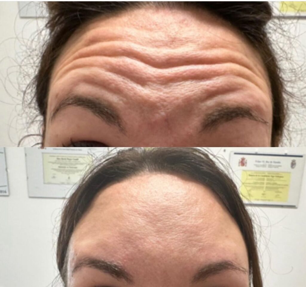 tratamiento facial antiarrugas
